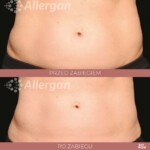 CoolSculpting przed po brzuch Katowice