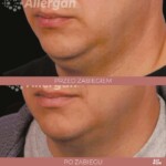 CoolSculpting rezultat podbródek Katowice
