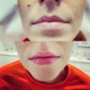 powiększanie ust juvederm katowice