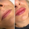 powiększanie ust juvederm katowice