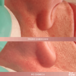 zamykanie naczynek alma harmony cena katowice