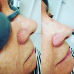 zamykanie naczynek katowice cena