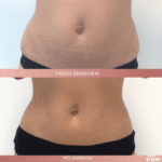 coolsculpting lipoliza cena katowice