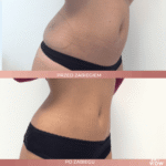 kriolipoliza coolsculpting brzuch efekt katowice