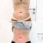CoolSculpting efekty