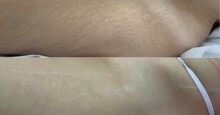 Dermapen