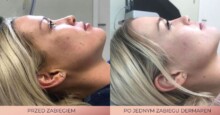 dermapen cena katowice