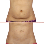 Efekty CoolSculpting