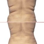 Efekty CoolSculpting
