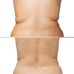 Efekty CoolSculpting