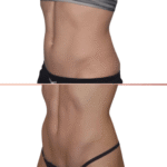 Efekty CoolSculpting