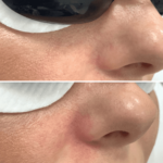 Laserowe usuwanie naczynek