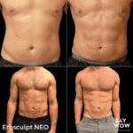 Emsculpt NEO - Say WOW Clinic