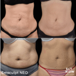 Emsculpt NEO - Say WOW Clinic