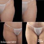 Emsculpt NEO - Say WOW Clinic
