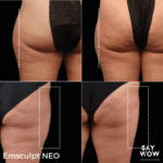 Emsculpt NEO - Say WOW Clinic