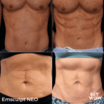 Emsculpt NEO - Say WOW Clinic