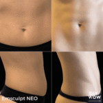 Emsculpt NEO - Say WOW Clinic